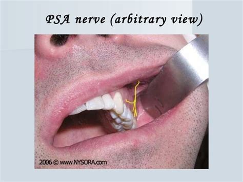 Posterior superior alveolar (psa) nerve block