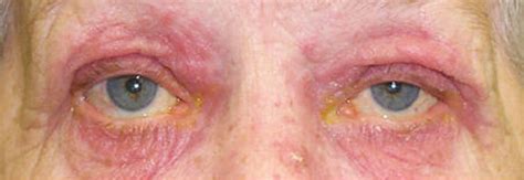 ocular rosacea - pictures, photos