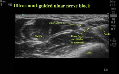 Ultrasound Guided Ulnar Nerve Block | Emory School of Medicine