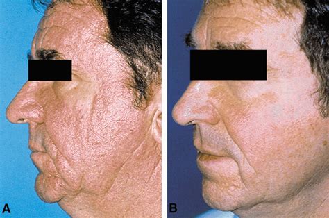 Sebaceous Gland Hyperplasia NYC- NYC Sebaceous Hyperplasia