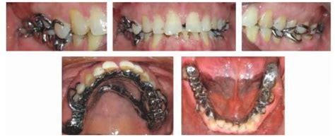 A Permanent solution to Restore Occlusal Vertical Dimension and Partial ...