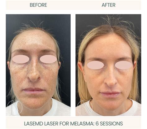 Best Melasma Laser Treatment in Fort Lauderdale, FL | Ayana Dermatology ...