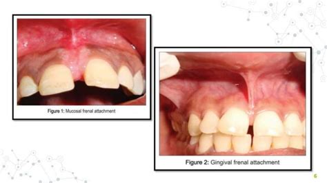 FRENAL ATTACHMENT & ITS MANAGEMENT | PPT