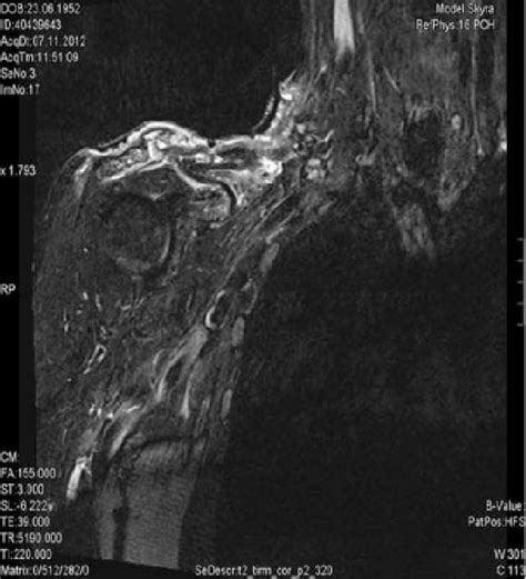 Preoperative magnetic resonance imaging (MRI) scan of the right ...