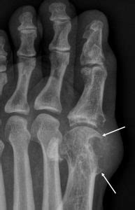 Gouty arthritis – Radiology Cases