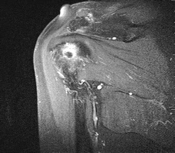 Calcific tendinitis of the rotator cuff associated with intraosseous loculation: Two case ...