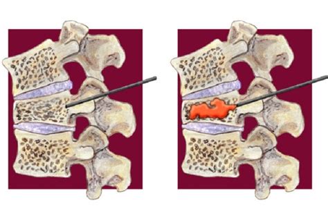 Percutaneous vertebroplasty safe and effective only in patients with acute fractures