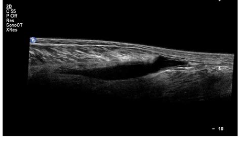 Gastrocnemius Tear Ultrasound