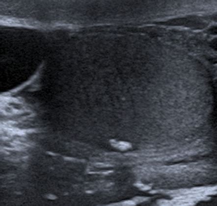 Scrotolith | Radiology Case | Radiopaedia.org