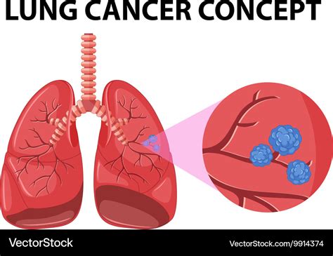 Diagram of lung cancer concept Royalty Free Vector Image