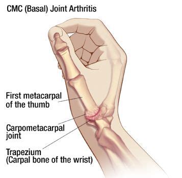 Thumb Arthritis: pain at the base of the thumb with increasing grip weakness - Hagerstown ...