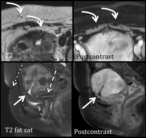 Cesarean section scar. From superficial to deep, there is an anterior ...