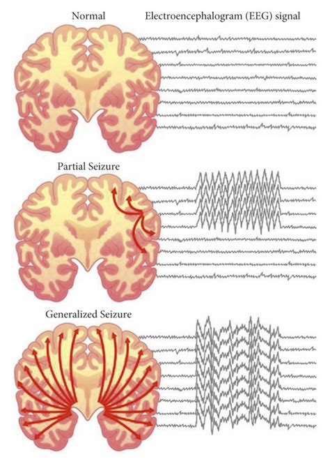 Comparison of the normal brain with partial (focal) seizure and... | Download Scientific Diagram