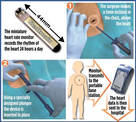 The boys who've been injected with their own heart monitors: British ...