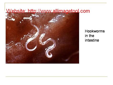 Dr.Moin's Blog: Ancylostomiasis