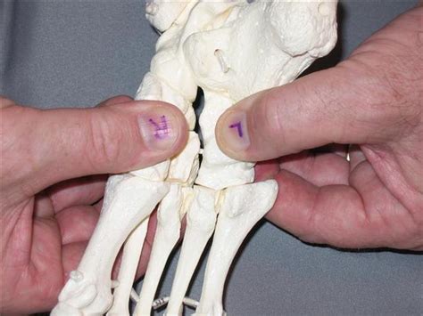 Cuboid Fracture Healing