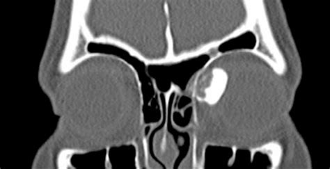 Orbital Osteoma