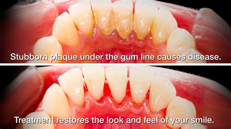 Scaling Of Teeth Before And After - TeethWalls