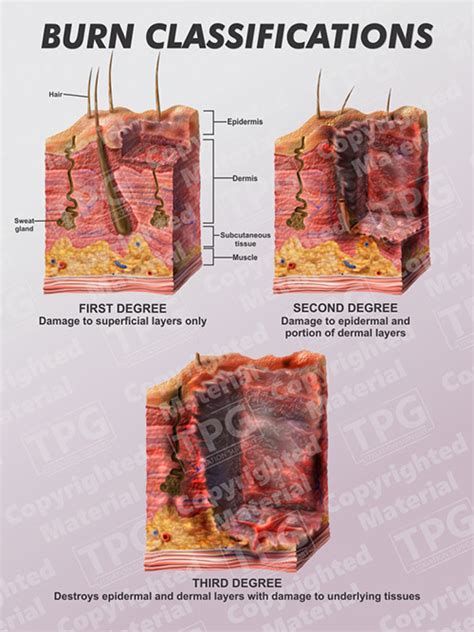 Burn Classifications - Order