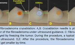 Symptoms of Fibroadenoma | MedicineBTG.com