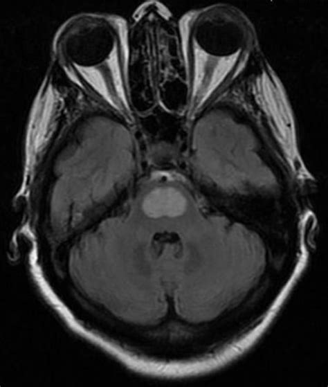 Understanding Central Pontine Myelinolysis | Radiology Case