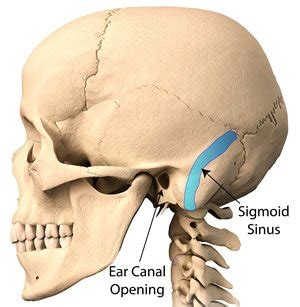 Pulsatile Tinnitus Caused by Sigmoid Sinus Dehiscence or Diverticulum ...