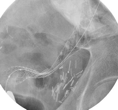 Update on the Indications and Use of Colonic Stents | SpringerLink