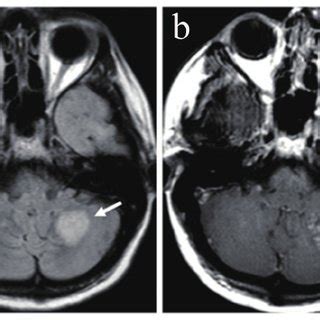 On month 4, MRI demonstrates a new 2-cm lesion in the left cerebellar... | Download Scientific ...