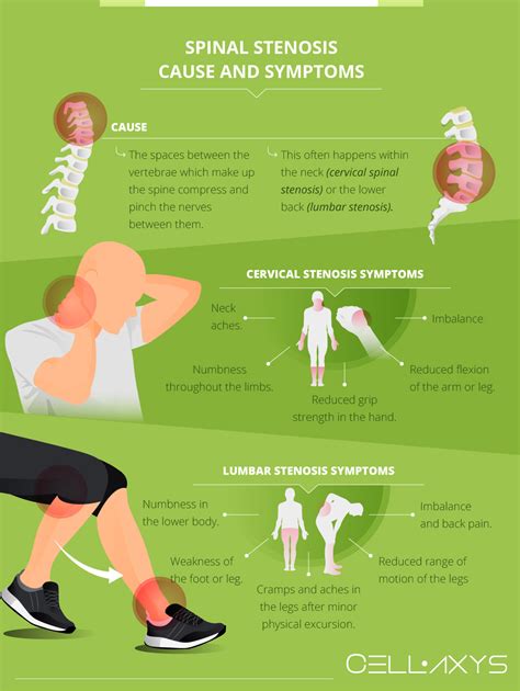 Is Stem Cell Therapy An Effective Treatment For Spinal Stenosis? - Cellaxys