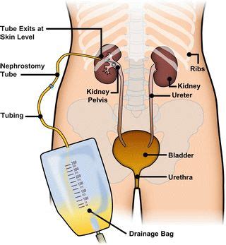 Ureteral Stents, Nephrostomy Tubes, and Urethral Dilators | Medical ...