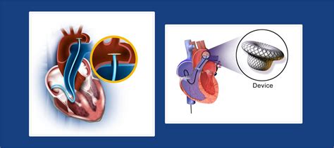 Device Closure of ASD, VSD and PDA | Ahmedabad | Dr. Subhash D. Chaudhari