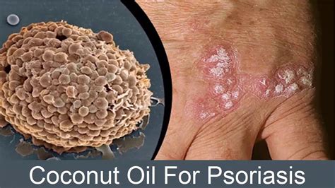 How Coconut Oil Is Beneficial For Treatment Of Psoriasis - YouTube