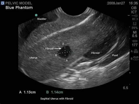 General Pathology Transvaginal Ultrasound Training Model