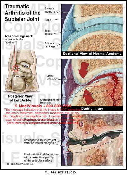 Traumatic Arthritis of the Subtalar Joint Medical Exhibit