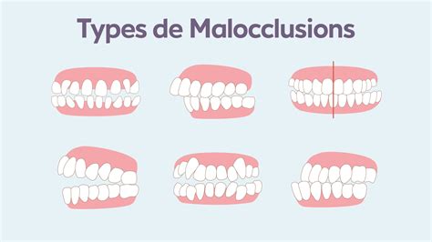 Malocclusion : types, conséquences et traitements