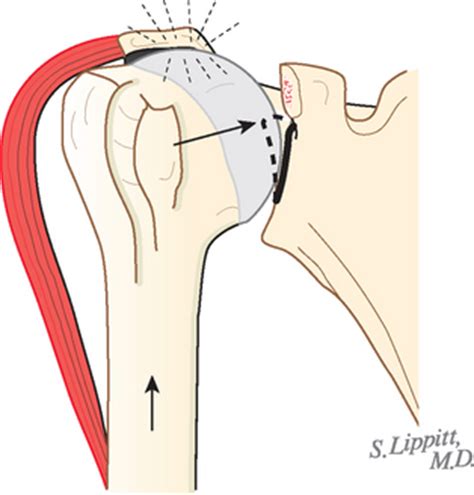 Glenohumeral Arthritis and Its Management | Musculoskeletal Key