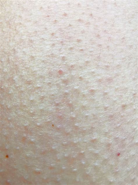 154 Goosebumps Skin Stock Photos - Free & Royalty-Free Stock Photos ...