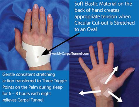 Carpal Tunnel Splints | Get The Facts | The Carpal Solution