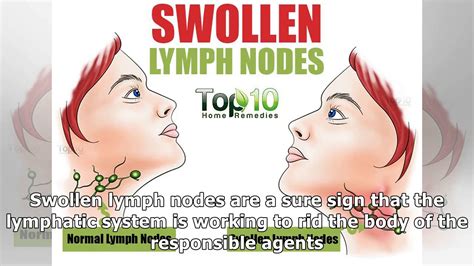 10 Home Remedies To Treat Swollen Lymph Nodes Naturally - YouTube