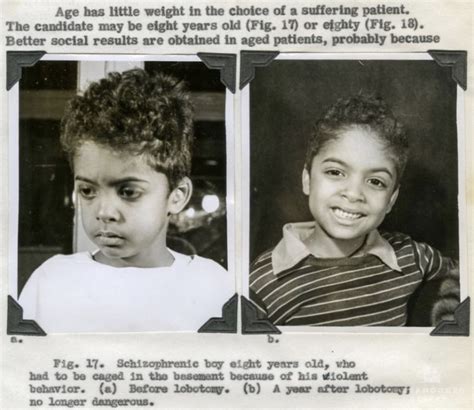 15 Lobotomy Patients Before And After Their Procedure