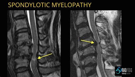 Spondylotic Myelopathy vs Myelomalacia: No more confusion | Radedasia