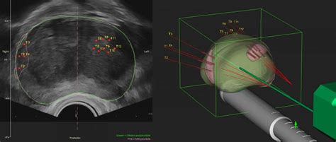 Dr Tim Nathan Urology | Robotic MRI-TRUS Fusion Transperineal Prostate Biopsy