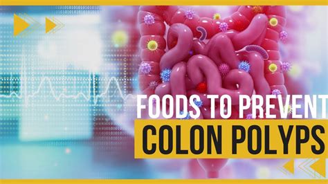 🔴 COLON POLYPS | The Best Foods To Prevent COLON POLYPS! - YouTube