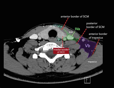 The Radiology Assistant : Cervical Lymph Node Map (2024)