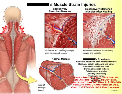 Muscle Strain Injuries