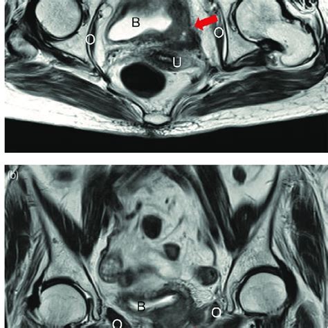 Intraoperative view of LRC. (a) The right side of the retropubic space ...