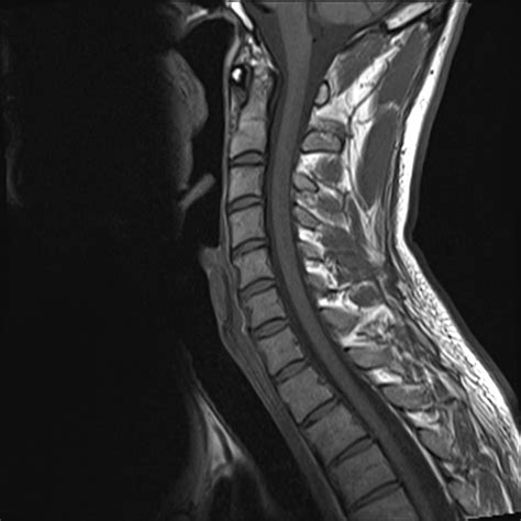 Normal Cervical Spine Mri | www.imgkid.com - The Image Kid Has It!