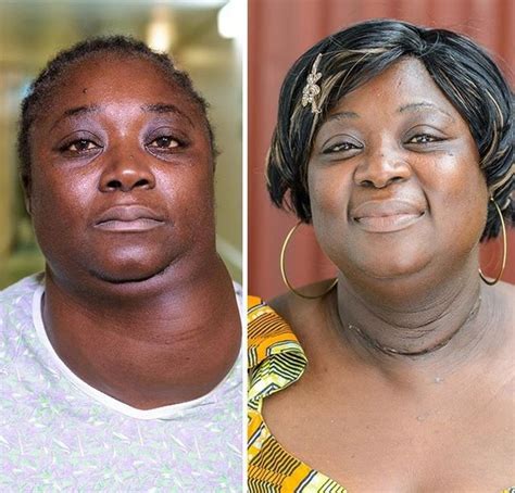 Woman's Goiter Of 10 Years Removed Via Surgery (Photos) - Health - Nigeria