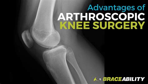 Benefits of Arthroscopic Knee Surgery | Cost & Laparoscopic Recovery