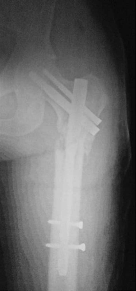 X‐ray image after surgical fixation with PFN and bone cement of the ...